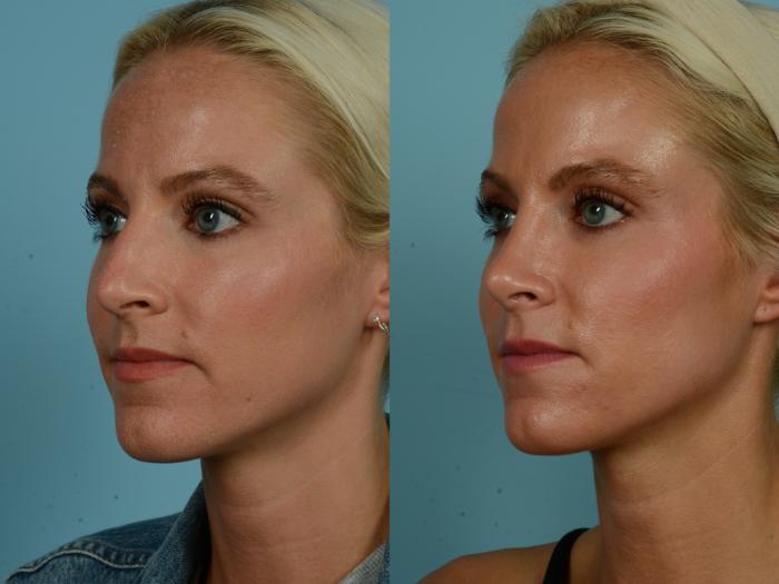 Before & After Rhinoplasty by Dr. Sinno Case 892 Left Oblique View in Chicago, IL
