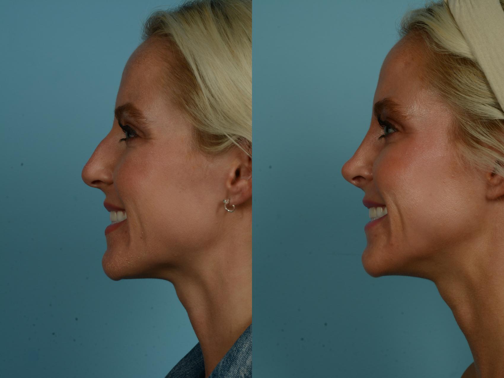 Before & After Rhinoplasty by Dr. Sinno Case 892 Left Side View in Chicago, IL