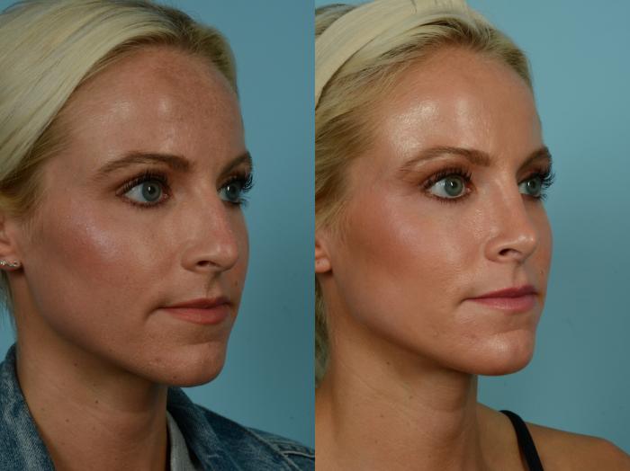 Before & After Rhinoplasty by Dr. Sinno Case 892 Right Oblique View in Chicago, IL