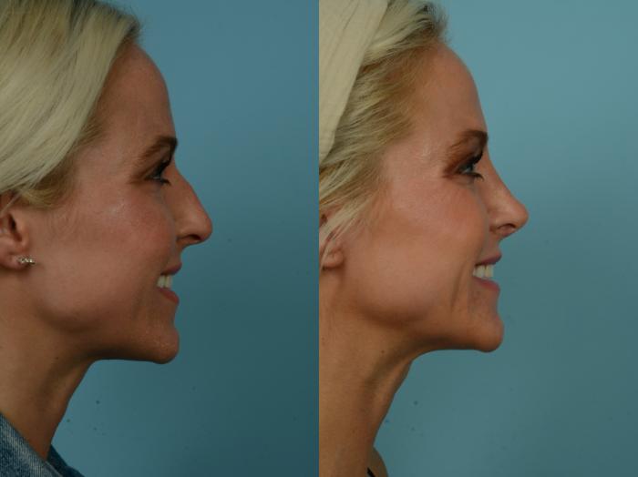 Before & After Rhinoplasty by Dr. Sinno Case 892 Right Side View in Chicago, IL