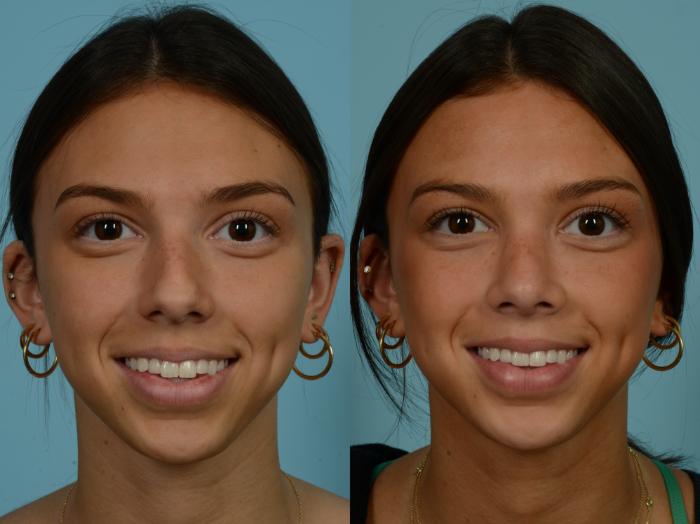 Before & After Rhinoplasty by Dr. Sinno Case 893 Front View in Chicago, IL