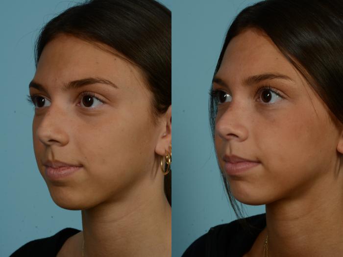Before & After Rhinoplasty by Dr. Sinno Case 893 Left Oblique View in Chicago, IL