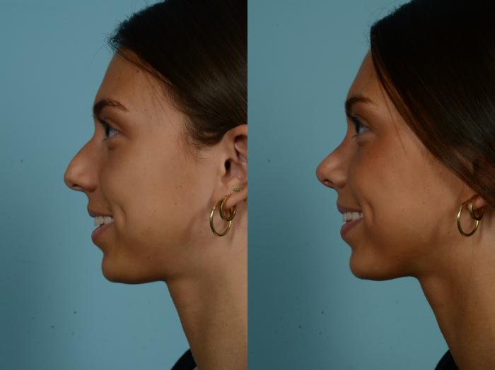 Before & After Rhinoplasty by Dr. Sinno Case 893 Left Side View in Chicago, IL