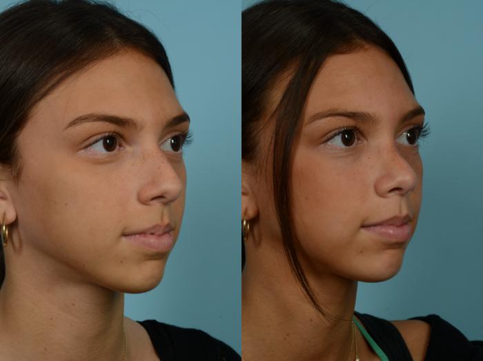 Before & After Rhinoplasty by Dr. Sinno Case 893 Right Oblique View in Chicago, IL