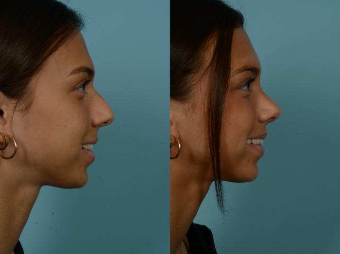 Before & After Rhinoplasty by Dr. Sinno Case 893 Right Side View in Chicago, IL
