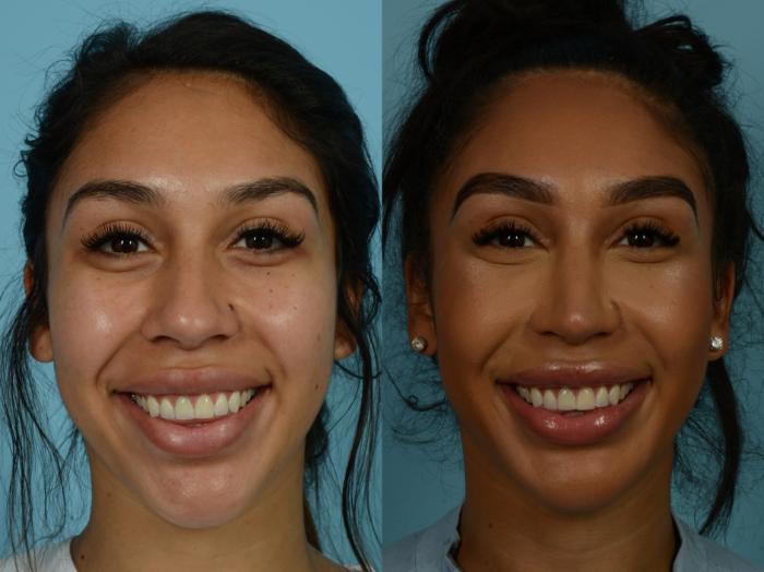 Before & After Rhinoplasty by Dr. Sinno Case 897 Front View in Chicago, IL
