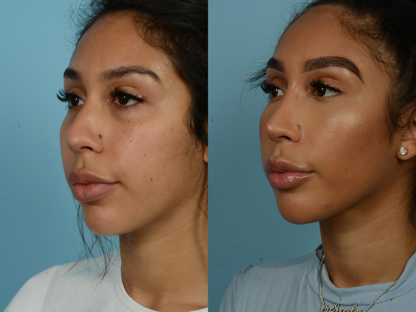 Before & After Rhinoplasty by Dr. Sinno Case 897 Left Oblique View in Chicago, IL