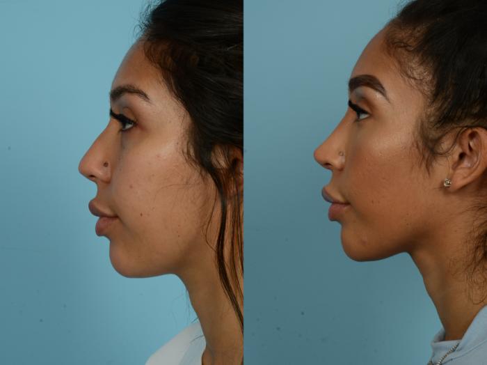 Before & After Rhinoplasty by Dr. Sinno Case 897 Left Side View in Chicago, IL