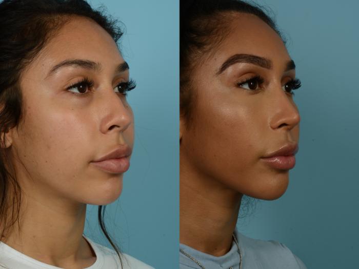 Before & After Rhinoplasty by Dr. Sinno Case 897 Right Oblique View in Chicago, IL