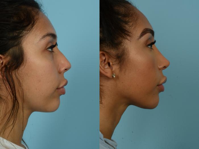 Before & After Rhinoplasty by Dr. Sinno Case 897 Right Side View in Chicago, IL