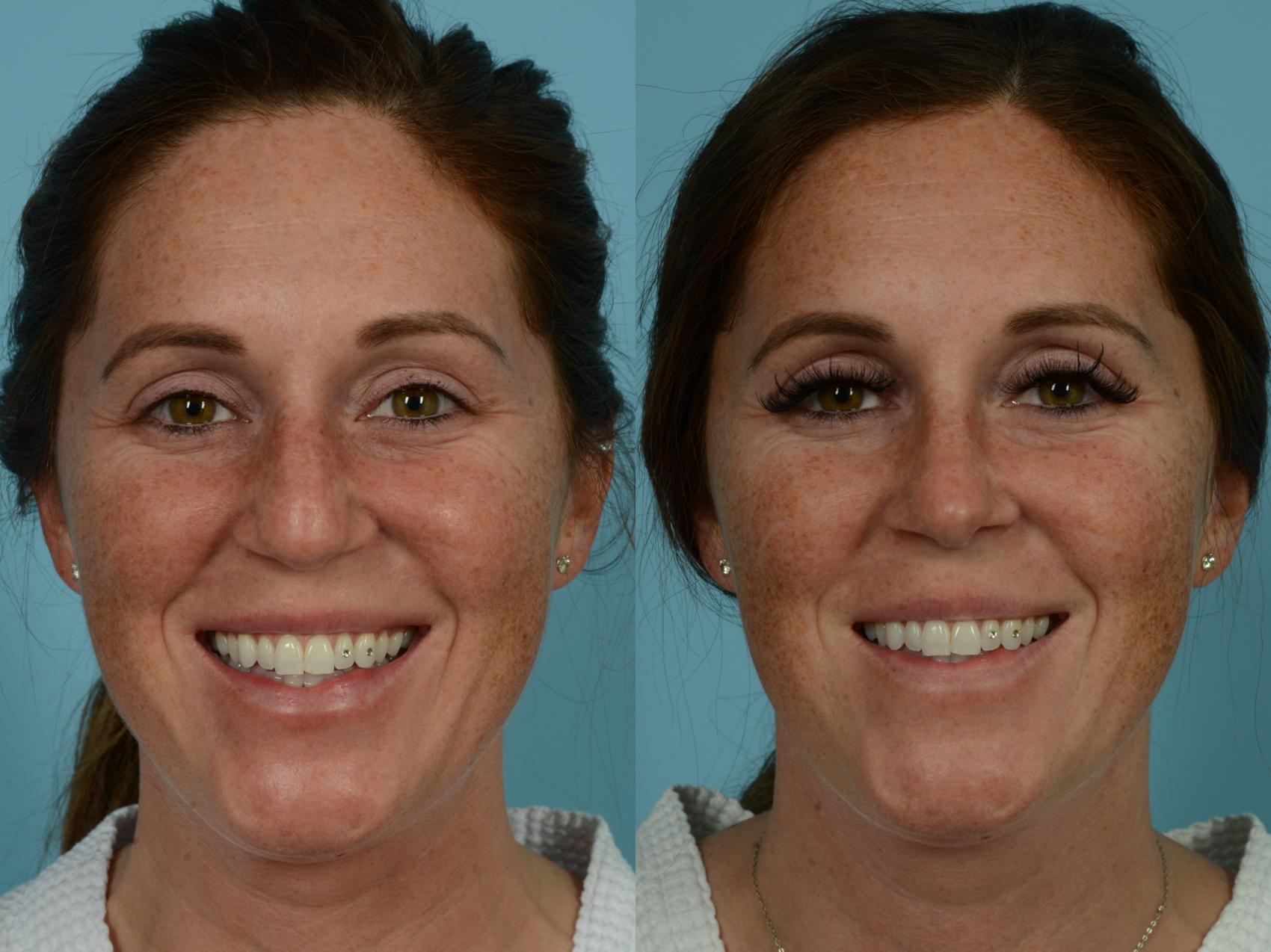 Before & After Rhinoplasty by Dr. Sinno Case 898 Front View in Chicago, IL