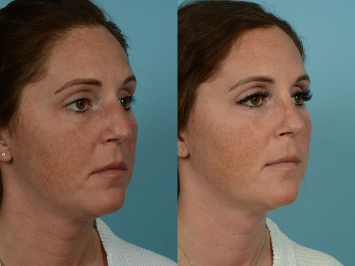 Before & After Rhinoplasty by Dr. Sinno Case 898 Right Oblique View in Chicago, IL