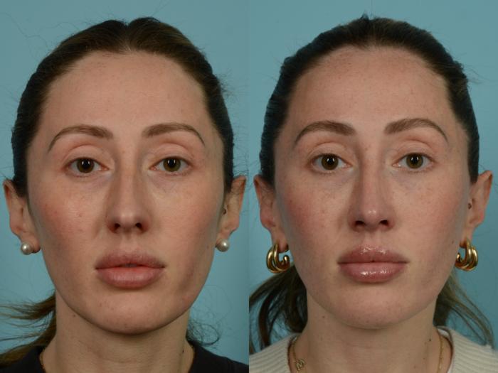 Before & After Rhinoplasty by Dr. Sinno Case 905 Front View in Chicago, IL