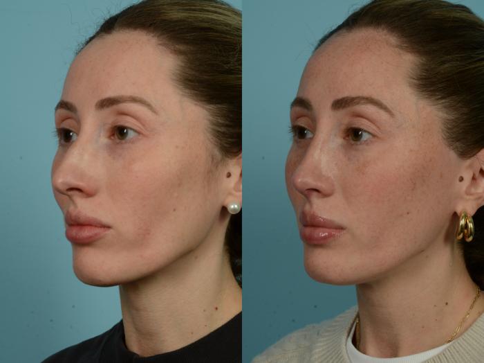 Before & After Rhinoplasty by Dr. Sinno Case 905 Left Oblique View in Chicago, IL