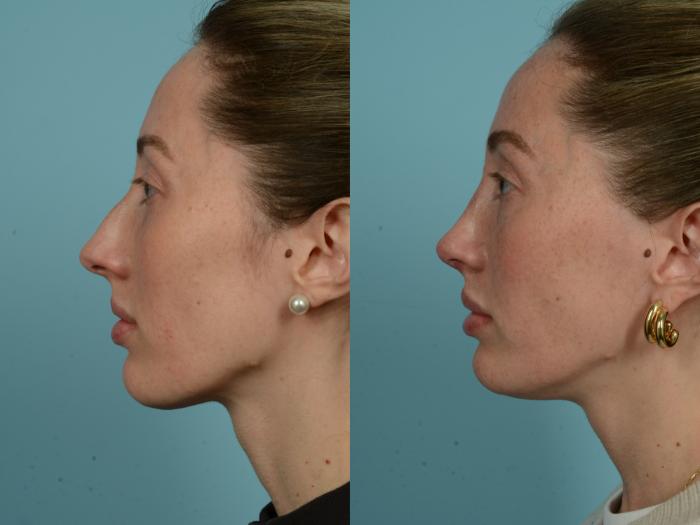 Before & After Rhinoplasty by Dr. Sinno Case 905 Left Side View in Chicago, IL