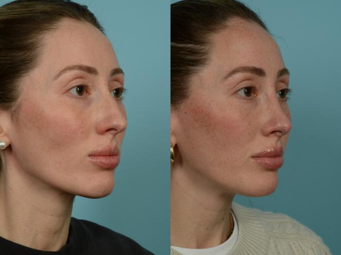 Before & After Rhinoplasty by Dr. Sinno Case 905 Right Oblique View in Chicago, IL