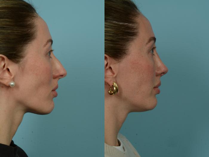 Before & After Rhinoplasty by Dr. Sinno Case 905 Right Side View in Chicago, IL
