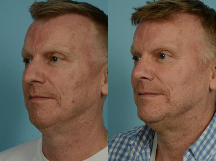 Before & After Rhinoplasty by Dr. Sinno Case 907 Left Oblique View in Chicago, IL
