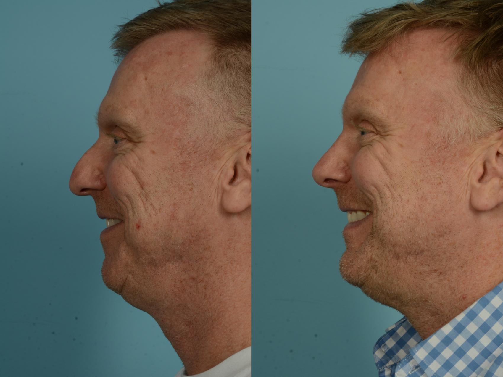 Before & After Rhinoplasty by Dr. Sinno Case 907 Left Side View in Chicago, IL