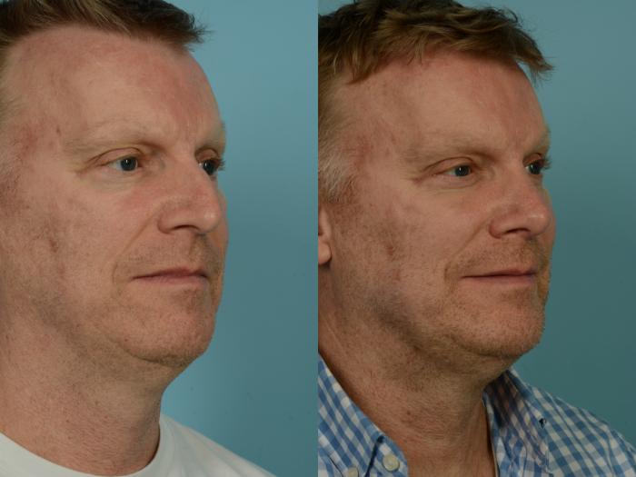 Before & After Rhinoplasty by Dr. Sinno Case 907 Right Oblique View in Chicago, IL