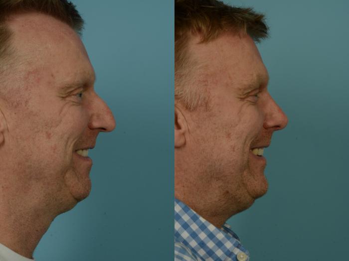 Before & After Rhinoplasty by Dr. Sinno Case 907 Right Side View in Chicago, IL