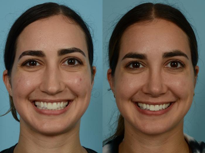 Before & After Rhinoplasty by Dr. Sinno Case 908 Front View in Chicago, IL