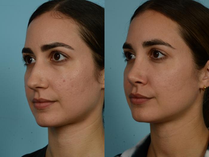 Before & After Rhinoplasty by Dr. Sinno Case 908 Left Oblique View in Chicago, IL