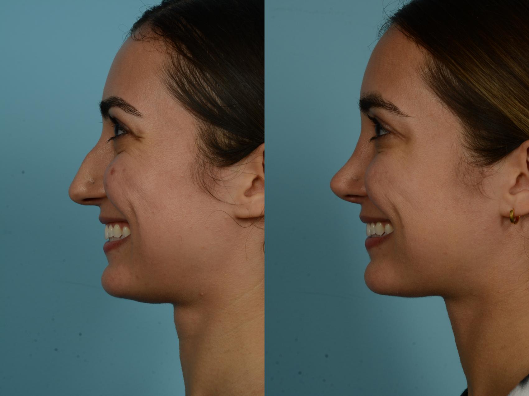 Before & After Rhinoplasty by Dr. Sinno Case 908 Left Side View in Chicago, IL