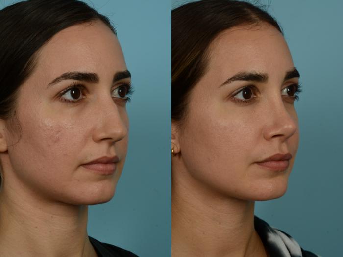 Before & After Rhinoplasty by Dr. Sinno Case 908 Right Oblique View in Chicago, IL