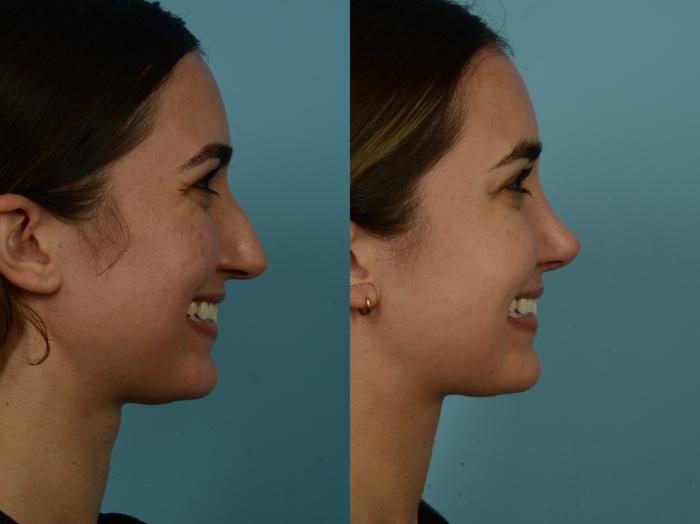 Before & After Rhinoplasty by Dr. Sinno Case 908 Right Side View in Chicago, IL