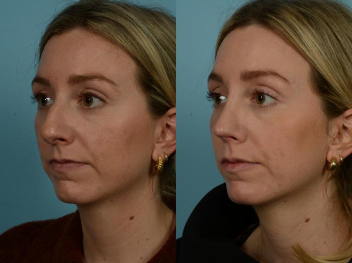 Before & After Rhinoplasty by Dr. Sinno Case 910 Left Oblique View in Chicago, IL