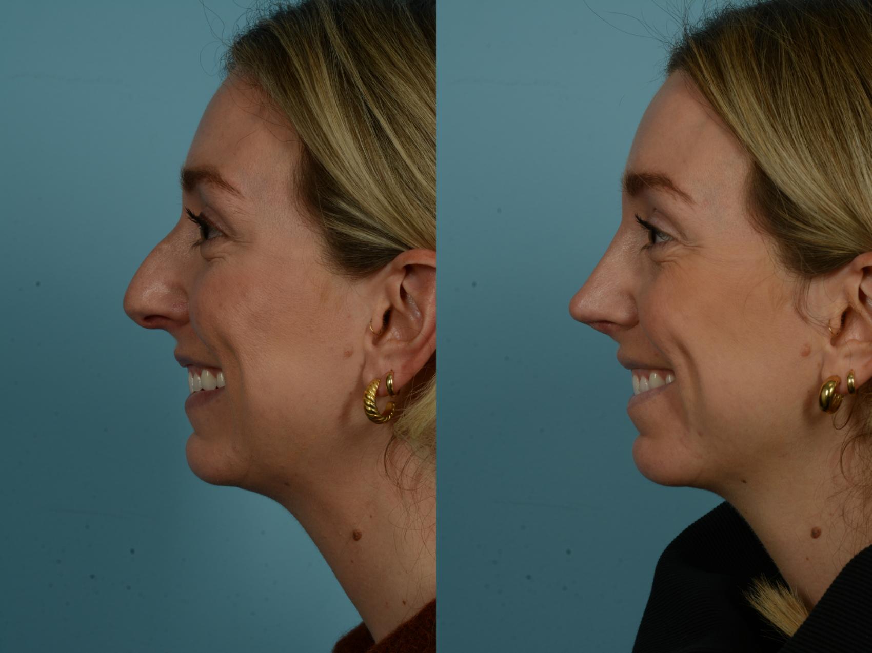 Before & After Rhinoplasty by Dr. Sinno Case 910 Left Side View in Chicago, IL