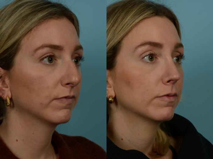 Before & After Rhinoplasty by Dr. Sinno Case 910 Right Oblique View in Chicago, IL