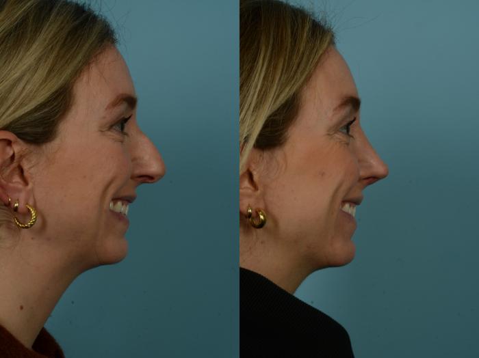 Before & After Rhinoplasty by Dr. Sinno Case 910 Right Side View in Chicago, IL
