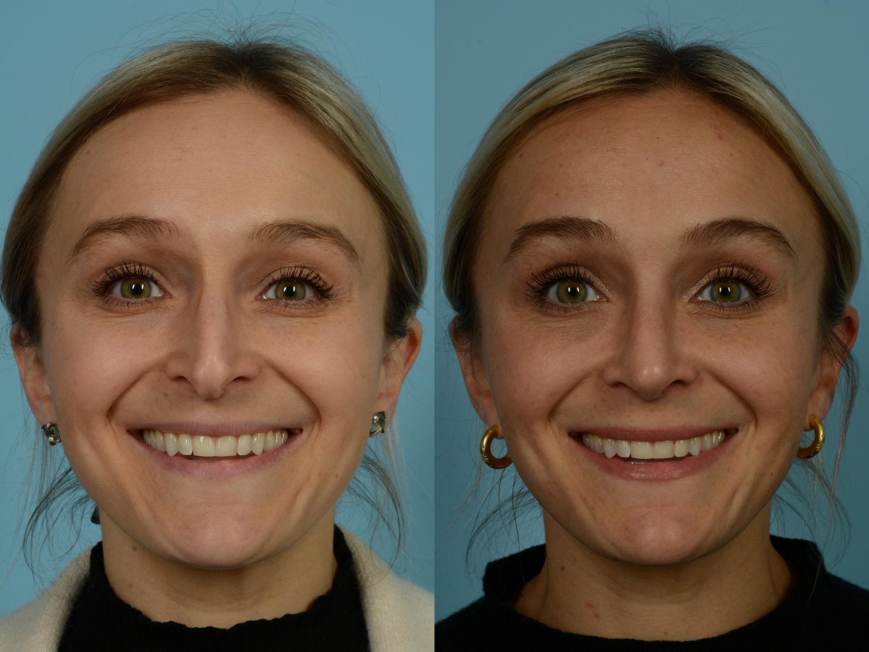 Before & After Rhinoplasty by Dr. Sinno Case 912 Front View in Chicago, IL