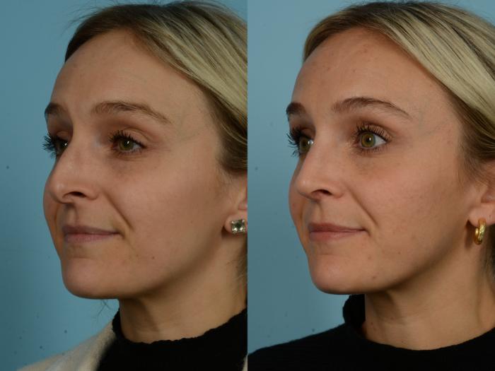 Before & After Rhinoplasty by Dr. Sinno Case 912 Left Oblique View in Chicago, IL