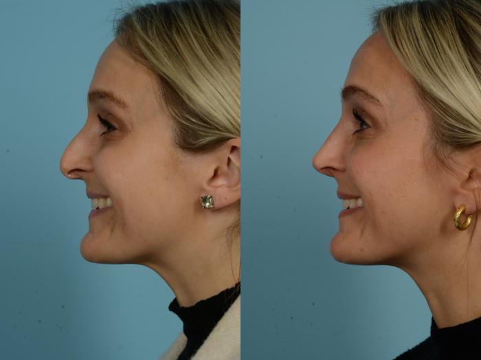 Before & After Rhinoplasty by Dr. Sinno Case 912 Left Side View in Chicago, IL