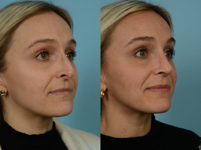 Before & After Rhinoplasty by Dr. Sinno Case 912 Right Oblique View in Chicago, IL