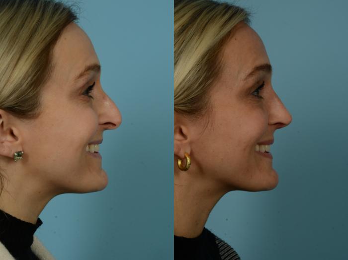Before & After Rhinoplasty by Dr. Sinno Case 912 Right Side View in Chicago, IL