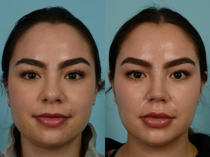 Before & After Rhinoplasty by Dr. Sinno Case 913 Front View in Chicago, IL