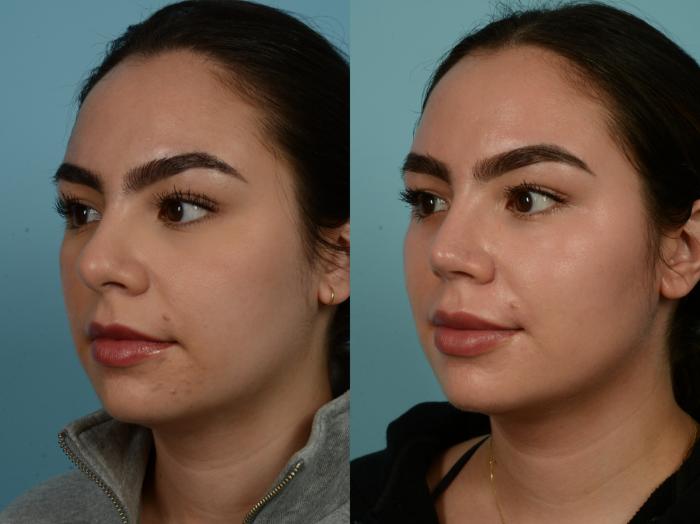 Before & After Rhinoplasty by Dr. Sinno Case 913 Left Oblique View in Chicago, IL