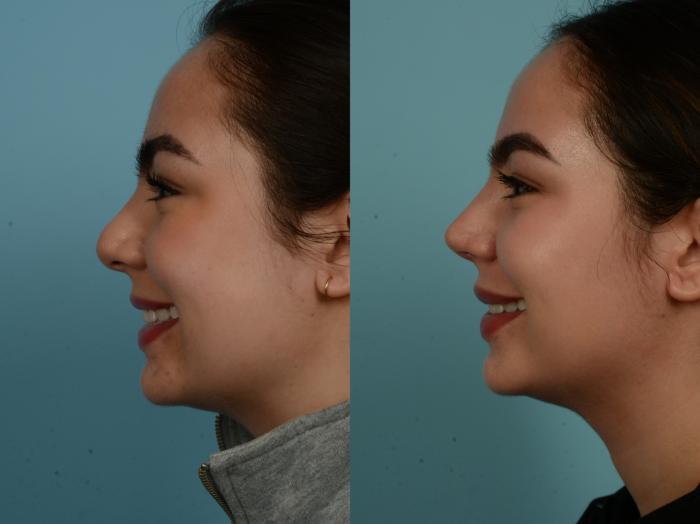 Before & After Rhinoplasty by Dr. Sinno Case 913 Left Side View in Chicago, IL