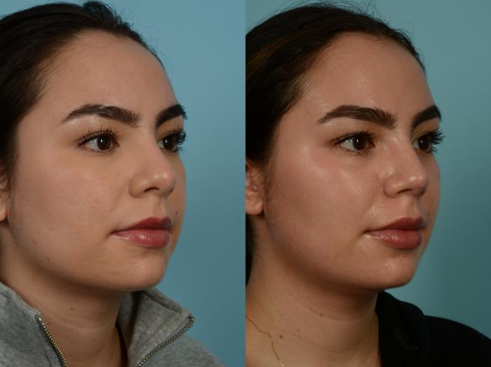 Before & After Rhinoplasty by Dr. Sinno Case 913 Right Oblique View in Chicago, IL