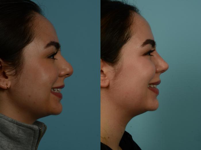 Before & After Rhinoplasty by Dr. Sinno Case 913 Right Side View in Chicago, IL