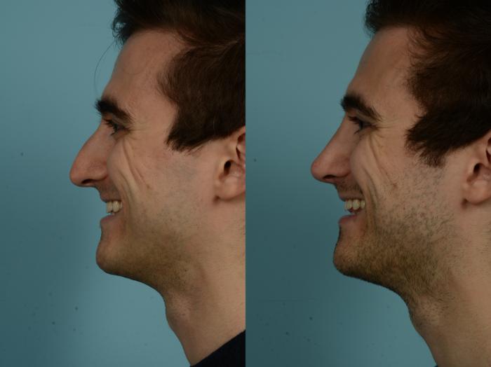 Before & After Rhinoplasty by Dr. Sinno Case 914 Left Side View in Chicago, IL