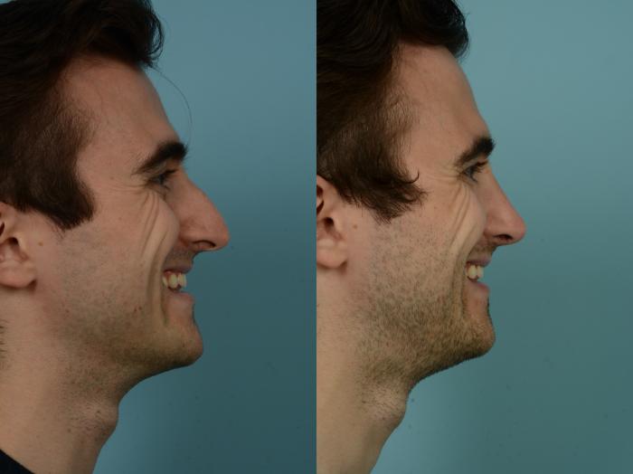 Before & After Rhinoplasty by Dr. Sinno Case 914 Right Side View in Chicago, IL