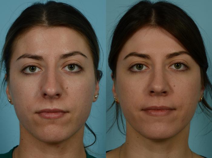 Before & After Rhinoplasty by Dr. Sinno Case 917 Front View in Chicago, IL