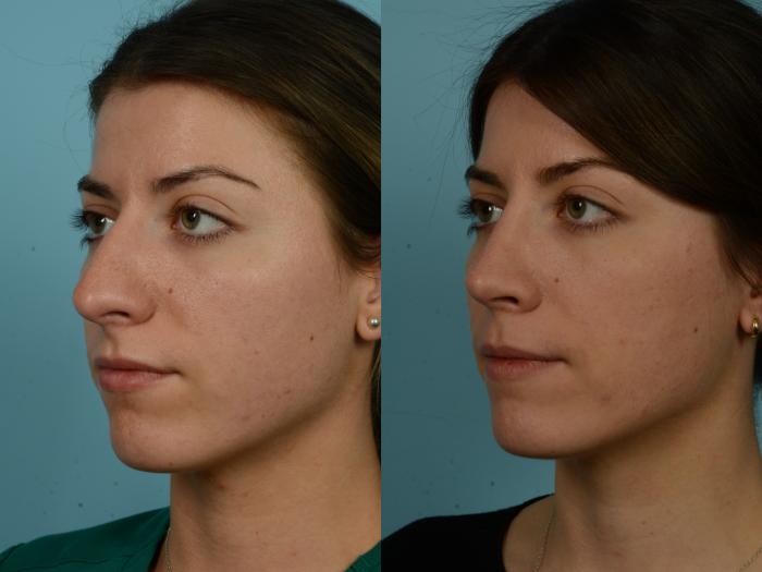 Before & After Rhinoplasty by Dr. Sinno Case 917 Left Oblique View in Chicago, IL
