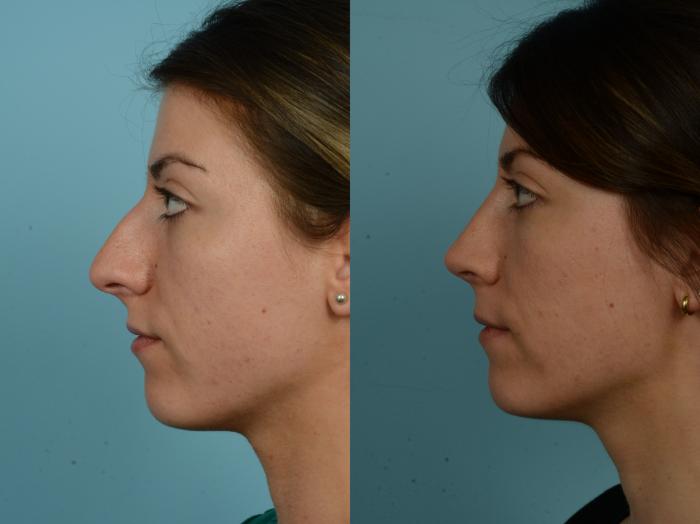 Before & After Rhinoplasty by Dr. Sinno Case 917 Left Side View in Chicago, IL