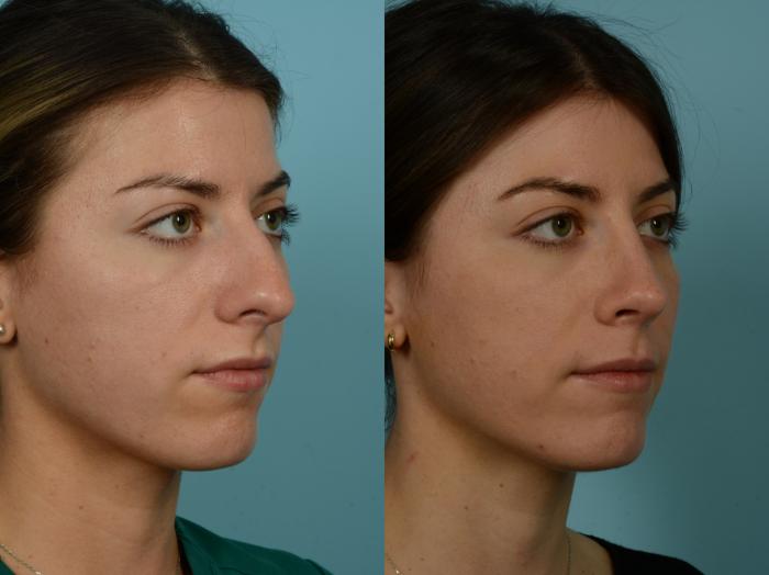 Before & After Rhinoplasty by Dr. Sinno Case 917 Right Oblique View in Chicago, IL